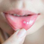 Esto puede significar sobre tu salud la aparición de ampollas ampollas