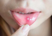 Esto puede significar sobre tu salud la aparición de ampollas ampollas