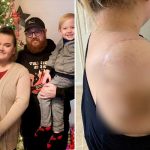 EE.UU: Joven pierde un brazo a causa de una bacteria carnívora estados unidos