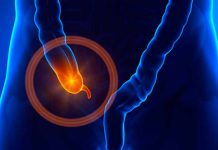 Conocé 6 señales de apendicitis que no son dolor abdominal tracto gastrointestinal