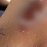 Bacteria carnívora deja graves heridas a niño que nadaba en la playa estados unidos