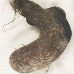 Rusia: Extraen una bola de pelos del tamaño de una bota del estómago de una niña rusia