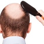 Insólito: La ciencia descubre cura contra la calvicie calvicie