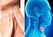 Todo lo que debes saber del silencioso cáncer de garganta cancer de garganta