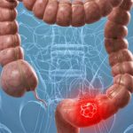 Científicos avanzan para mejorar detección de cáncer de colon cancer de colon
