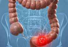 Científicos avanzan para mejorar detección de cáncer de colon cancer de colon