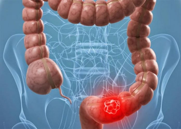 canc_zcsvD0h cancer de colon