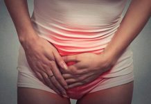 candidiasis