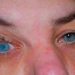 Edimburgo: Parásito de agua deja ciega a una mujer escocia