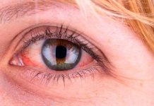 ¿Ojos rojos o amarillos? Esto es lo que su color dice sobre tu salud salud visual