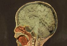 Mira como quedo el cerebro de un niño después de chupar pintura