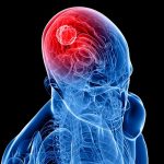 cancer cerebral