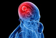 cancer cerebral