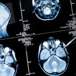 Vacuna contra el cáncer cerebral pasa con éxito primera etapa de ensayos clínicos salud