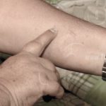 Ojo con la picazón nocturna, usted puede tener chinches de cama