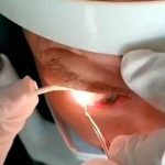 China: Extraen 20 gusanos del ojo a un hombre de 60 años china