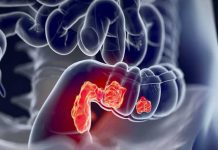 Alerta en Paraguay por aumento de casos de cáncer de colon paraguay
