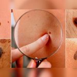 ¿Qué lunares pueden ser malignos? Un médico explica regla para identificarlos