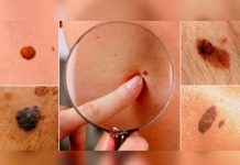 ¿Qué lunares pueden ser malignos? Un médico explica regla para identificarlos