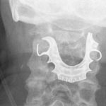 Hombre de 72 años vive con una dentadura postiza atorada en la garganta hombre