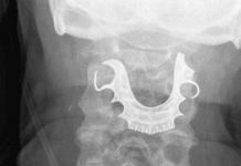 Hombre de 72 años vive con una dentadura postiza atorada en la garganta hombre