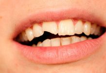 Los alineradores invisibles podrían sustituir a los brackets los alineadores