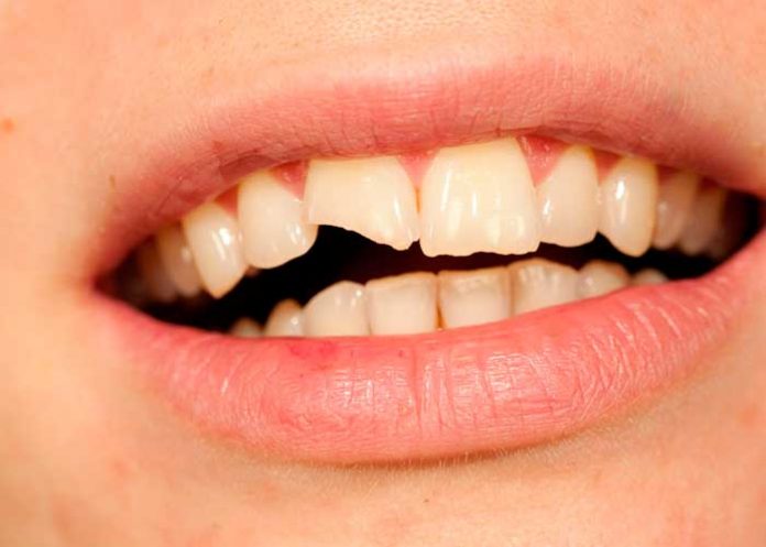 dien los alineadores