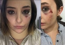 Discusión entre actores deja con una herida abierta a Elisa Vicedo actriz