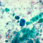 El parásito intestinal que se convirtió en enfermedad de transmisión sexual parasito intestinal