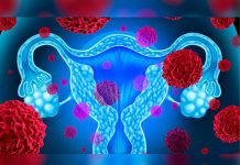 Síntomas de la endometriosis que no debes pasar por alto endometriosis
