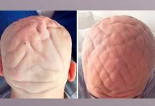 Acromegalia y cutis verticis gyrata: dos enfermedades raras que pueden existir acromegalia