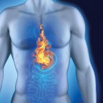 reflujo gastroesofagico