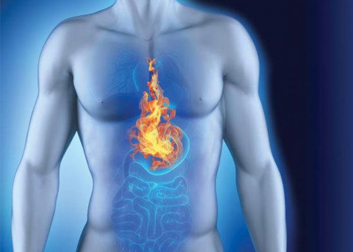 reflujo gastroesofagico