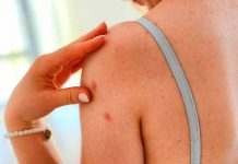 Estas son las causas del acné en la espalda y así puedes combatirlo acne