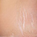 Atención: ¿sabes qué tipo de estrías tenés y cómo tratarlas? salud