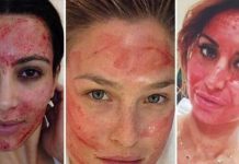 Mujeres contraen VIH al realizarse famoso «Facial de vampiro» estados unidos