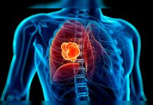 El cáncer de pulmón es el más letal de América Latina cancer de pulmon