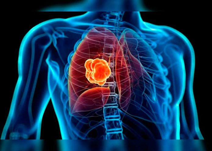 cancer de pulmon