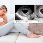 Todo lo que tienes que saber del embarazo anembrionario embarazo anembrionario