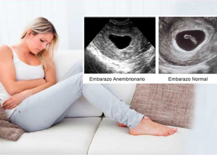 embarazo anembrionario