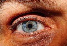 Pensó que tenía una basurita en el ojo pero en realidad era algo peor estados unidos
