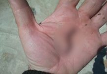 Mujer tenía una molestia en el pie y lo que le encontraron fue asqueroso mujer