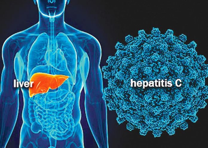 hepatitis c