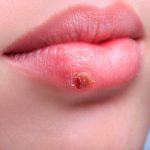 herpes labial