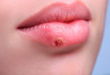 herpes labial