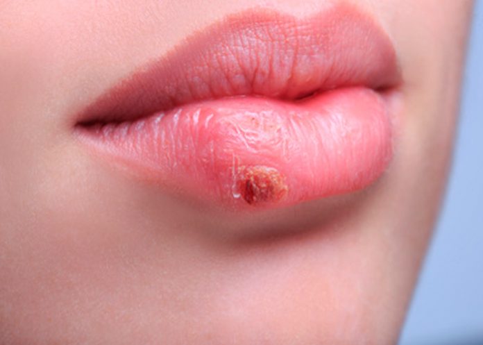 herpes labial