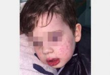 Beso maldito: Niño casi pierde la vista al ser contagiado de herpes