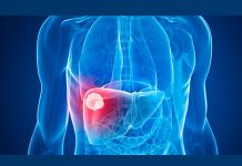 !Atención! Mujeres padecen menos cáncer de hígado mujeres