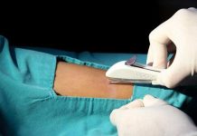 Le colocaron implante anticonceptivo en su brazo y acabó en su pulmón europa