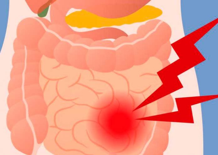 sindrome del intestino irritable